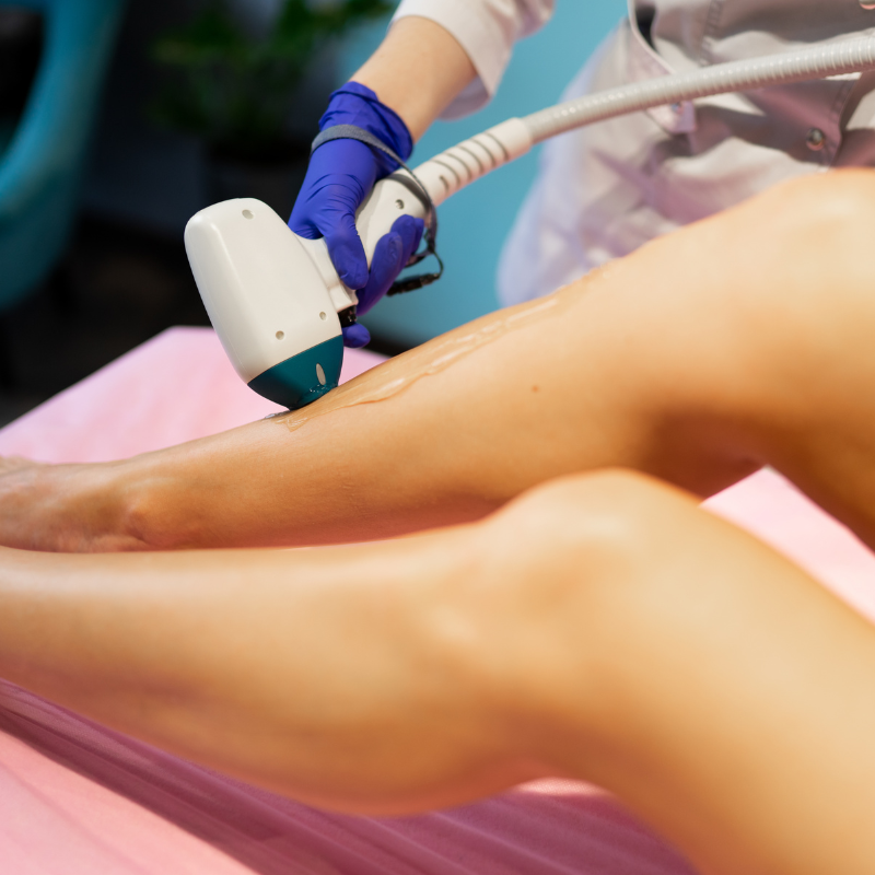 Depilación láser pierna