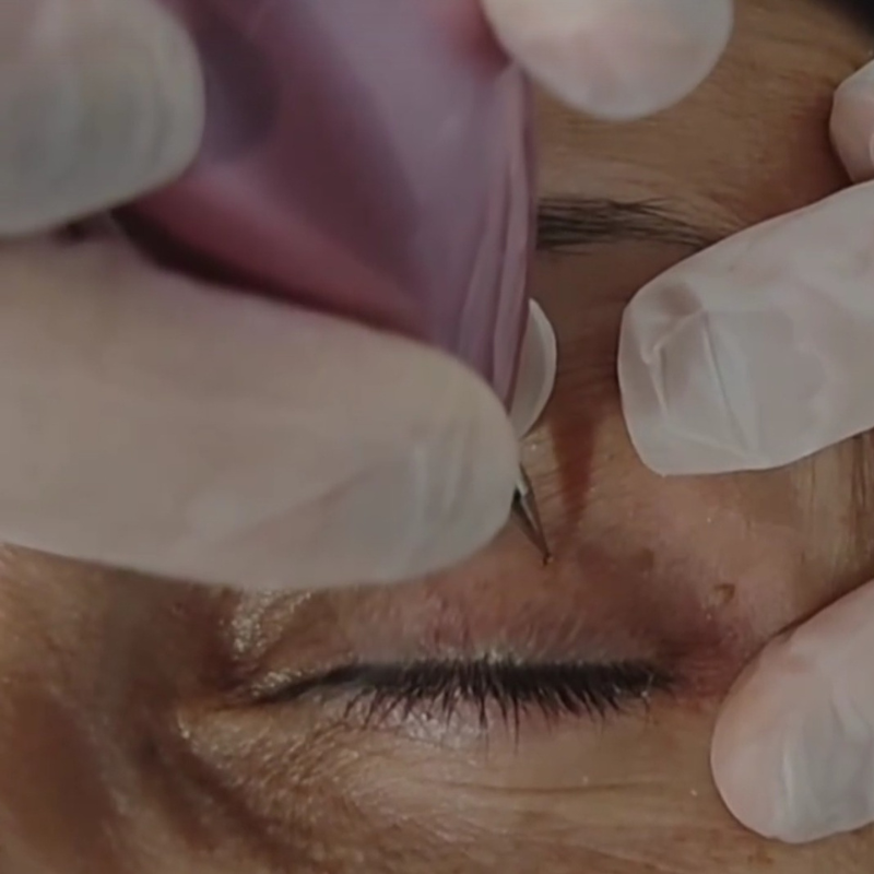 Depilación láser plasma