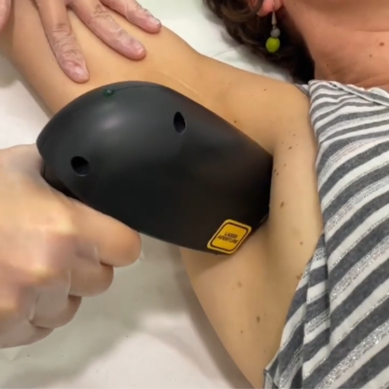 Depilación láser por zona